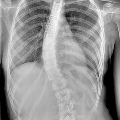 Scoliosis-X-Ray Diagnosis
