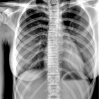 scoliosis-after-treatment Treatment