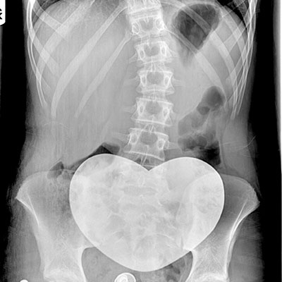 scoliosis-diagnosis Diagnosis of Scoliosis