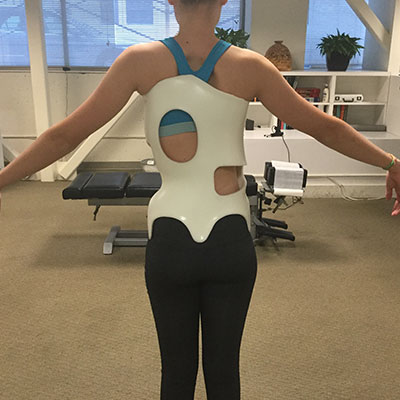 scoliosis-example Bracing